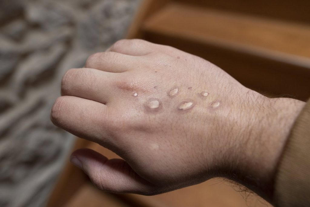 La OMS informa de que el 90% de los nuevos casos notificados de mpox se concentran en África