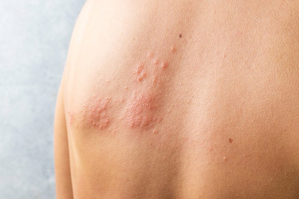 La vacuna contra el herpes zóster podría reducir el riesgo de infarto e ictus